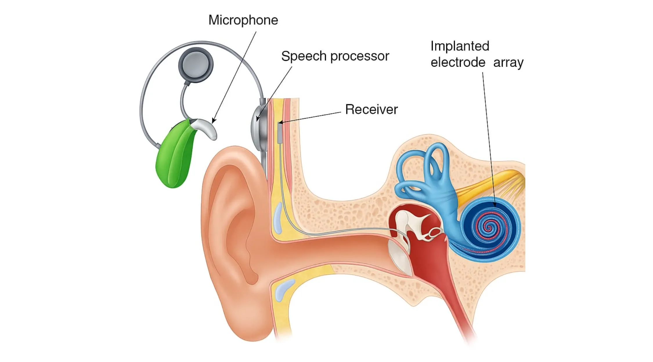 Cochlear Implant Surgery